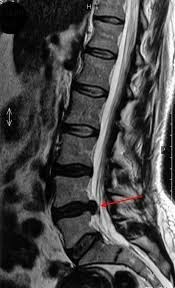 Фото грыжи позвоночника на мрт